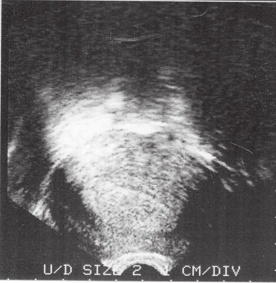 Normalt endometrium Endometrieundersökning bör ske vaginalt.