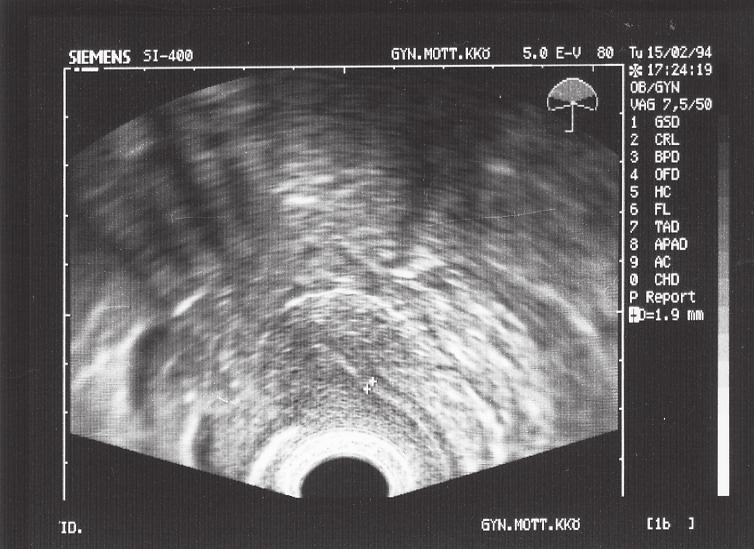 I follikelfasen ses en lågekogen endast några mm tjock enskiktad slemhinna. En vecka innan ovulationstid får endometriet ett typiskt treskiktat utseende (Fig 10).