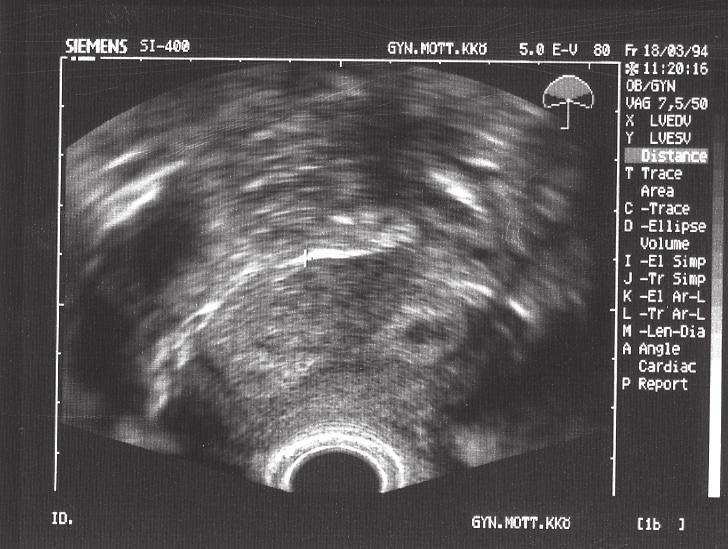 Fig 15. Uterus septus i tvärsnitt. Fig 16. Vaginal ultraljudsbild av myom där penetrationen ej är tillräcklig varför bildkvaliteten blir dålig.