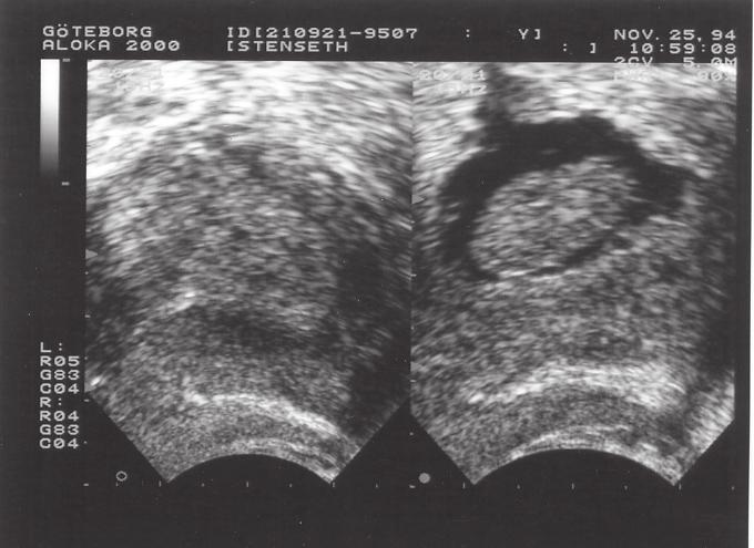 Uterus Vid adenomyos är uterus oftast generellt lätt förstorad.