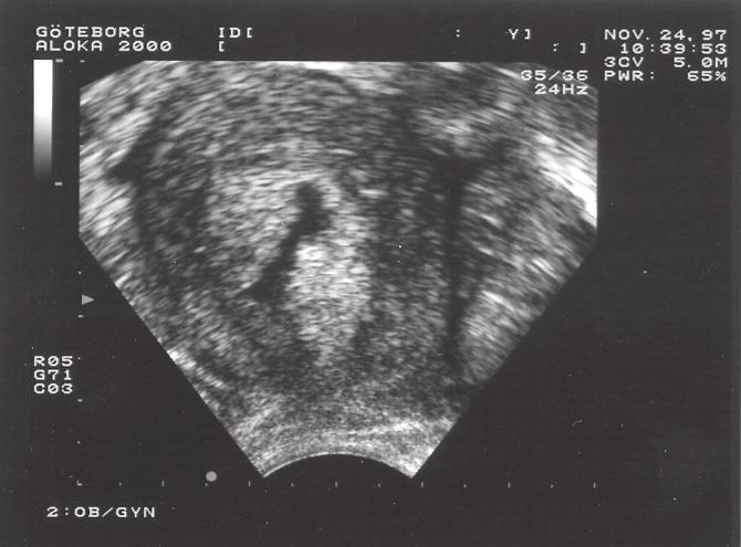 Fig 20. Endometriecancer med vätskespalt. längs- som tvärläge skall kontrolleras i förhållande till kaviteten.