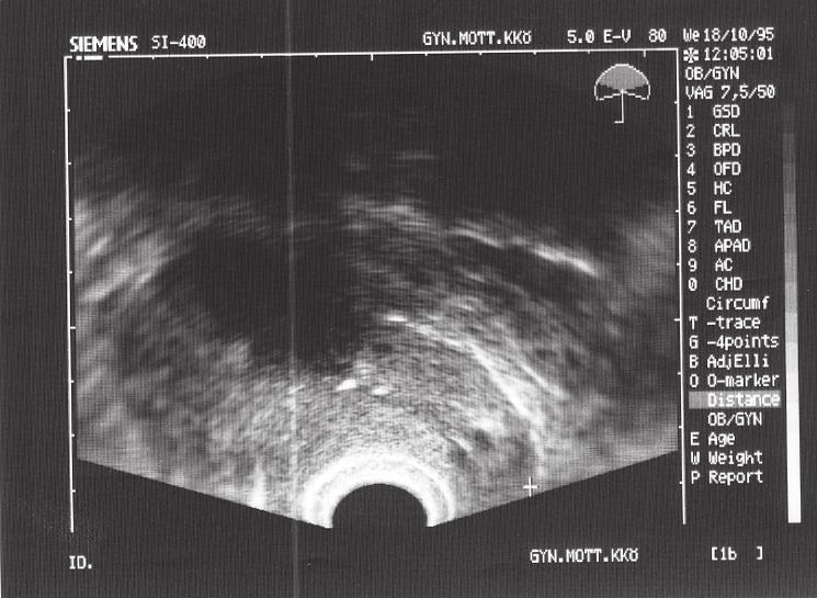 Eller också att använda en riktig rektal givare med roterande kristaller. Det finns studier där denna typ av givare används för att bedöma infiltration av cervixcancer i parametriet (4).