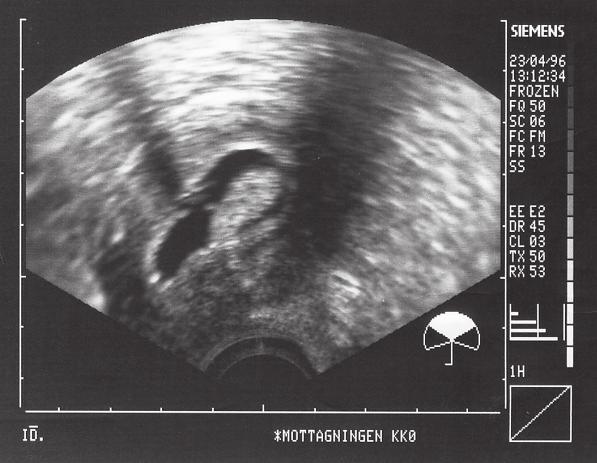 Uterus Fig 24. Tunt endometrium och endometriepolyp. Fig 25. Intrakavitärt myom. koksaltlösning i kaviteten göra dessa förändringar bättre synliga. För att utföra detta föres en kateter in via cervix.