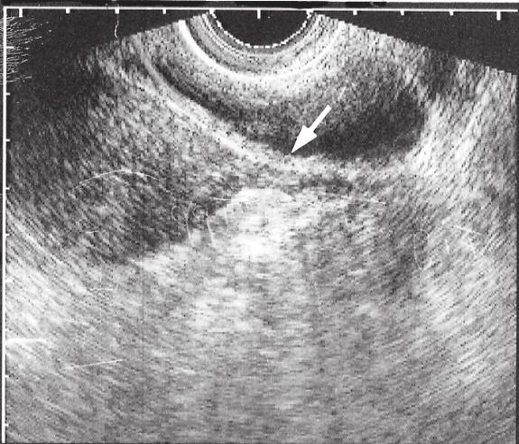 Tubor Tubor Connie Jörgensen, Olle Carlström Friska tubor är åtta till tio centimeter långa med endast en till två millimeter lumen. De är belägna på sidor om och ofta bakom uterus.