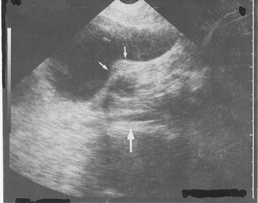 Ovarier Fig 31. Abdominell ultraljudsbild av ett ovarium (pilar). Iliakakärlen (pil) ses i ansluting till ovariet Fig 32. Vaginal ultraljudsbild av ett ovarium (O).