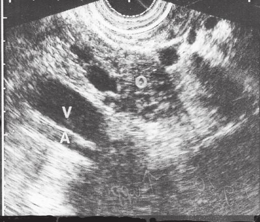 Man hittar ovarierna en bit ifrån uterus, inte sällan förskjutna lateralt av tarm, som glider ner då blåsan är tom. Iliacakärlen ses ofta pulserande strax intill ovarierna (Fig 31).