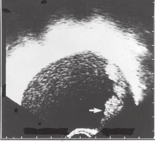 Ekofria enrummiga cystor är sällan maligna (96 procent av sådana tumörer var benigna) (21). Detta gäller även om cystan är mycket stor. Stora Fig 40.