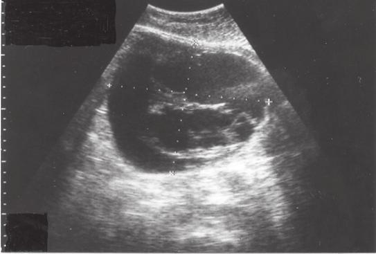 Ovarier Fig 41. Abdominell ultraljudsbild av serös ovarialcancer med septa av olika tjocklek.