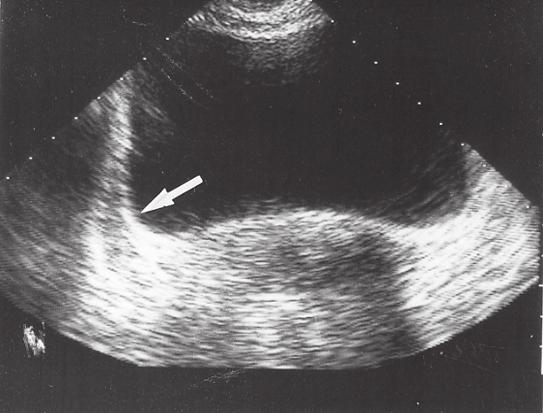 Fig 44. Abdominell ultraljudsbild visade ett tvärsnitt av lilla bäckenet. Musculus obturatorius internus ses vid pilen.