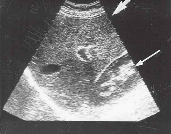 Även små blåstumörer kan diagnostiseras, och man kan även se tumörväxt i blåsväggen (Fig 46).