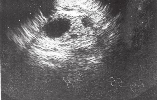 Tecken på ovulation: Den dominanta follikeln återfinnes ej. På dess plats ses en mindre, tjockväggig struktur corpus luteum.