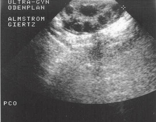 med såväl abdominellt som endovaginalt ultraljud (18,19). Det är ofta men inte obligat förstorat och i allmänhet påfallande runt till formen (20).