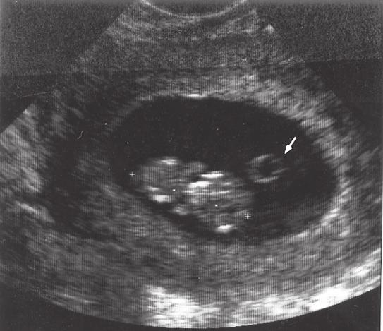 Fig 61. Vaginal ultraljudsbild. Foster med CRL två till tre millimeter. Hjärtaktivitet fanns.