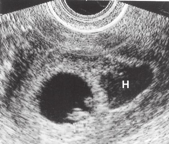 För att termen ofostrig graviditet (blighted ovum) skall kunna användas måste hinnsäcken ha uppnått en diameter på 16 millimeter vid vaginal undersökning utan att ett foster kan påvisas (Fig 64).