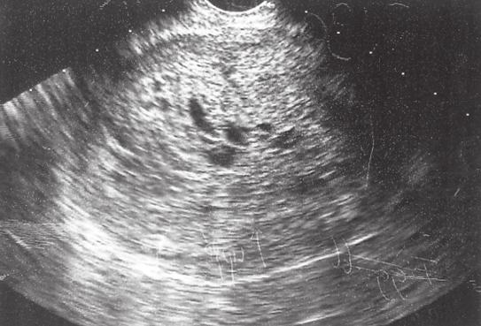 Tidig graviditet Fig 65. Vaginal ultraljudsbild av uterus i tvärsnitt. I kaviteten ses ekotäta abortrester. Fig 64. Vaginal ultraljudsbild av en patologisk intrauterin graviditet.