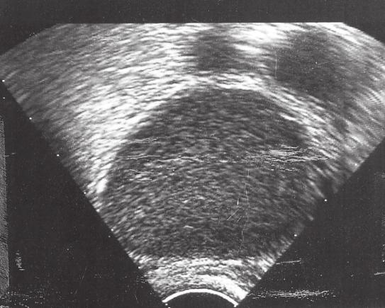 erfar smärta efter punktion. Den kan bero på en liten intraabdominell blödning. Värken viker i regel på lätta analgetika. Infektioner är en allvarlig komplikation inte minst till follikelpunktion.