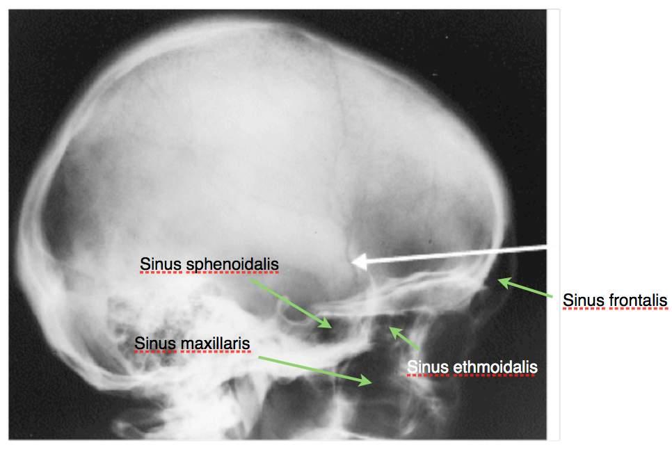 a) b) A. Sinus frontalis: Meatus nasi medius B. Sinus sphenoidalis: Recessus sphenoethmoidalis C. Sinus maxillaris: Meatus nasi medius D.