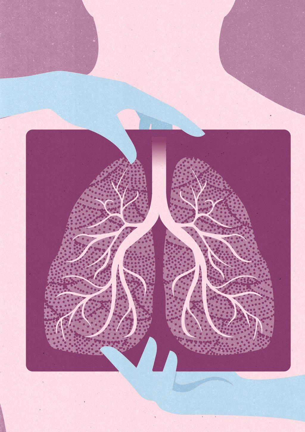 Lungfibros EN SKRIF T OM LUNGFIBROS