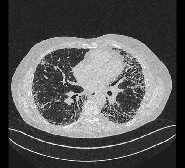 8 HJÄRT-LUNGFONDEN Vid idiopatisk lungfibros börjar förändringarna i lungvävnaden i utkanten av lungan och sprids sedan inåt.