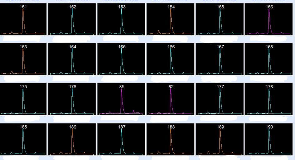 Resultat Totalt analyserades 3233 prover på Capillarys 3 TERA för att upptäcka Hb-varianter genom att studera kromatogram. De proverna med en atypisk profil visas i figur 1 med en lila linjering.