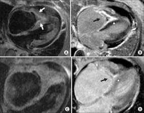 Polyneuropati, cardiomyopati Drabbar