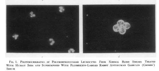 2018-04-19 16 ANCA historik 1959- P. Calaberesi fluorescent anti-globulin studies. 1974- A.