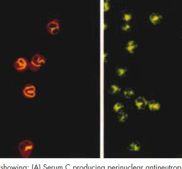18 Problem runt IIF för ANCA Interferens från ANA Formalin formalin fixerade neutrofiler Hep-2 cells eller lymphocytes för att skilja ANA/ANCA Fler