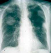 ANCA vaskulit och lungor Granulom Hosta