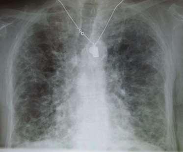 Konsolideringar HRCT eller BAL Lungfibros
