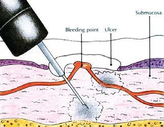 Injektionsbehandling vasokonstriktor sklerosant Värmekoagulering laser värmeprob (heater probe) monopolar koagulering multi/bipolar koagulering Vävnadslim lokalt trombin (Tisseel) cyanoakrylat