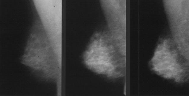 Mammografisk täthet Eva Lundström Inledning Mammografisk täthet har kommit i fokus under senare år.