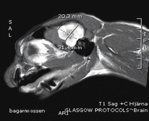 Denna ses i anslutning till en extraaxial massa, efter intravenös kontrastgiva (16). Det tros uppstå till följd av en hypervaskulär icke neoplastisk reaktion (28).