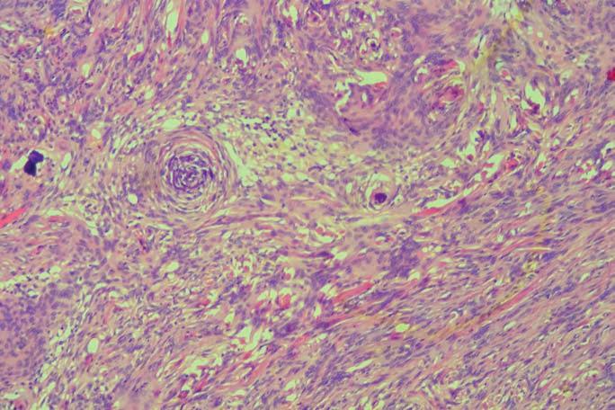 stort antal patienter som studerats retroaktivt där korrekt diagnos ställts efter histologisk undersökning.