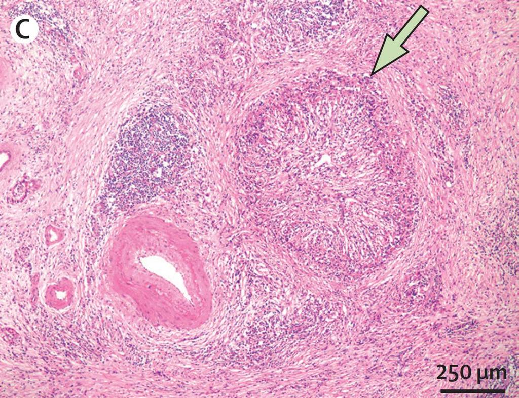 Inflammation i vener Kamizawa T