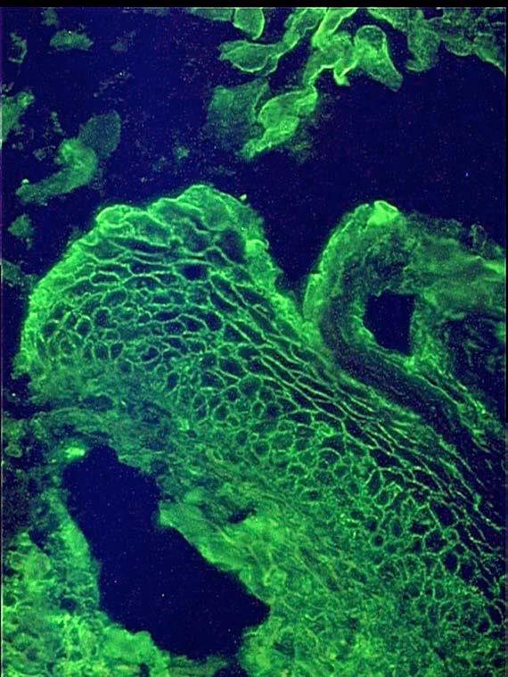 Olika mekanismer vid autoimmun sjukdom (Cooms & Gell): Typ II (antikroppar mot cell/matrixbundna