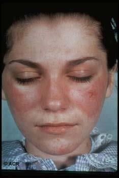 Systemisk lupus erythematosus (SLE) 85% kvinnor,