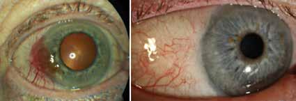 Behandlingen av uvealt melanom syftar till att bibehålla syn och förhindra uppkomst av metastaser.