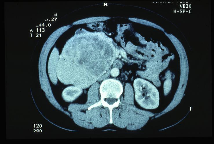 Ny CT inom 1-3 månader (MTO-PET) Metastas?