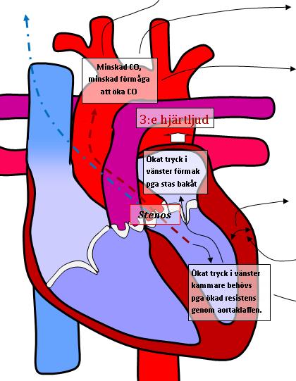 Aortastenos Diagnoser bakom arytmierna - Fibros med SND och AV-Block - Akut