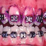 3 Applikation av Duraphat 22,6 mg/ml dentalsuspension minskar bevisat djupet av