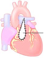 Pulmonalisatresi med intakt