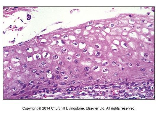 Höggradig intraepitelial skivepitellesion (HSIL) HSIL rekommenderas som diagnostisk term.