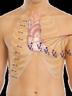 2014%04%21 Elektrodernasbestämdaanatomiska posi.oner V10V2(Kallas högerkammaravledning.deta dåderasplaceringgöratde anatomisktbästrepresenterar hjärtatshögrakammare. v30v4:kallasanteriora.