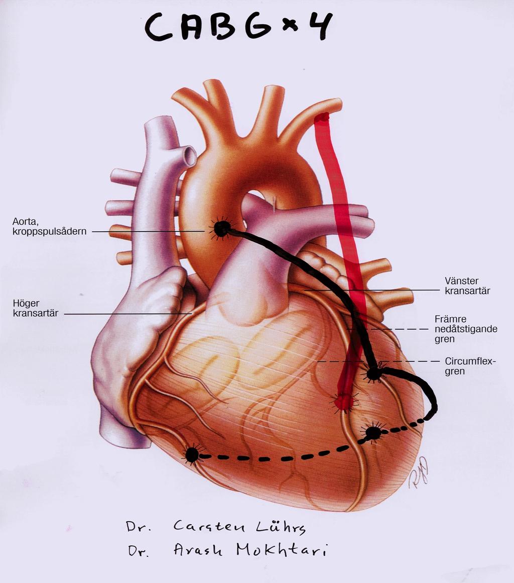 2014%04%21 CoronarArteryByPassGraFing,CABG Hjärtatshistologi