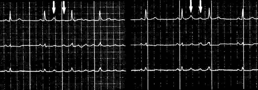 den elektriska ledningshastigheten [9] som förmaksrepolarisationen och därmed refraktäriteten [8, 10].