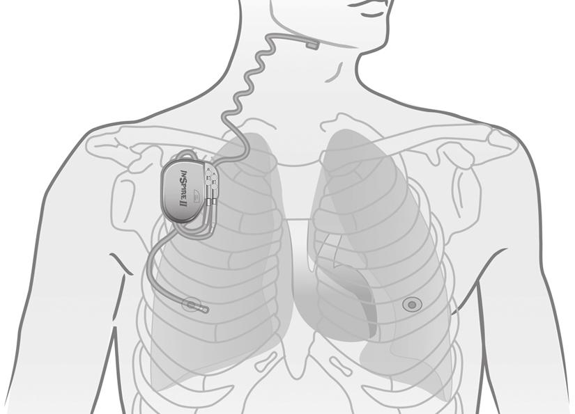 3. Inspire-stimuleringsterapi för övre luftväg Ditt Inspire-system Stimuleringsledning Stimulator Respiratorisk avkänningsledning Bild 2.