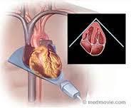 Varför fickultraljud; focused cardiac ultrasound? Hjärtsvikt är vanligt.