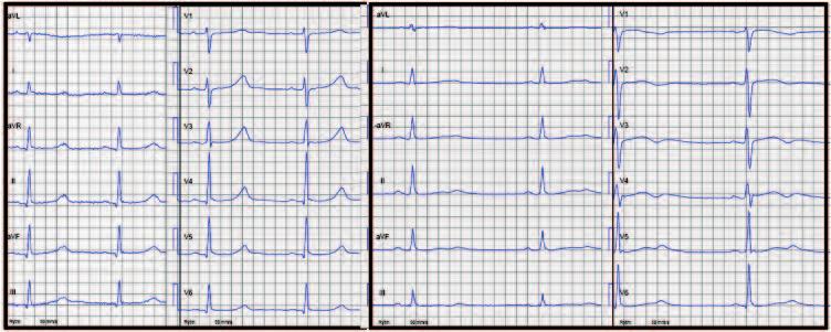 klinik och vetenskap Figur 4. EKG från patienter med olika varianter av långt QT-syndrom. Till vänster: LQTS1 med mutation i KCNQ1. Till höger: LQTS2 med mutation i KCNH2.