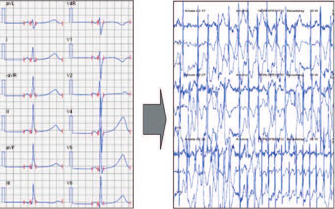 klinik och vetenskap Figur 6. EKG från patient med katekolaminerg polymorf ventrikeltakykardi (CPVT). Till vänster: Vilo-Ekg.