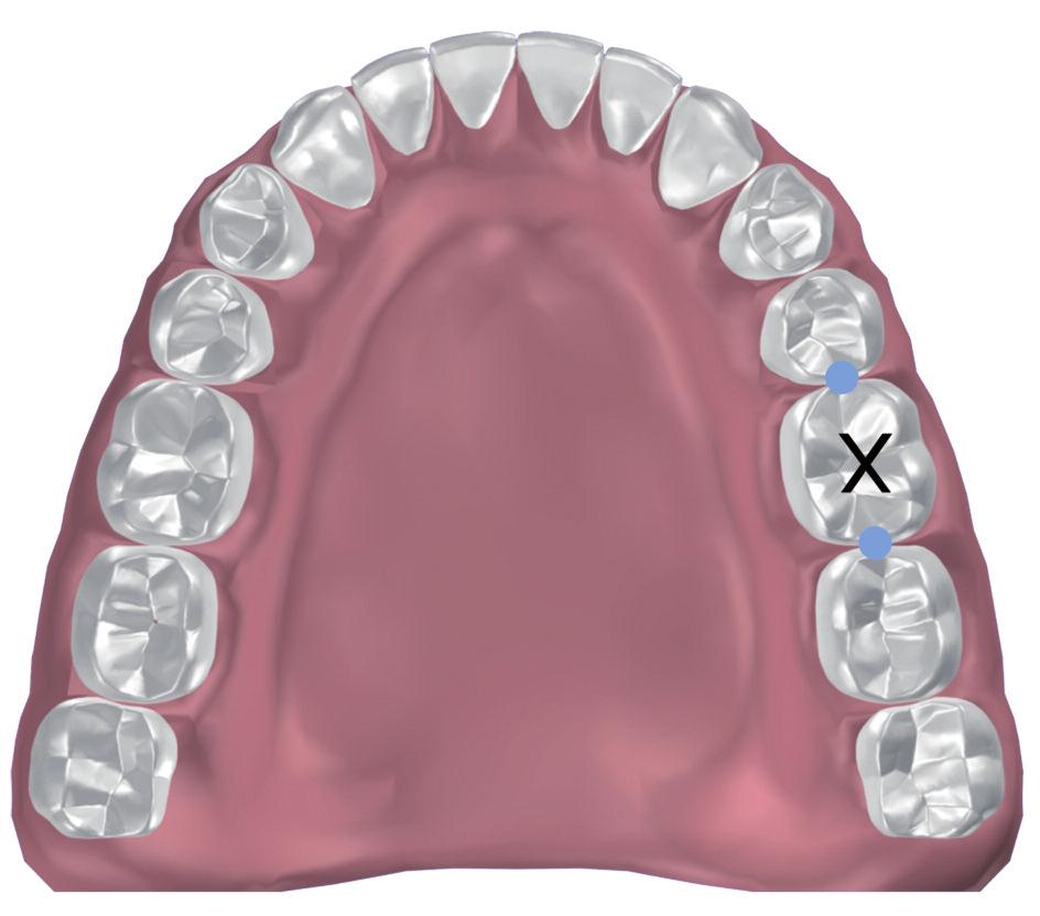 Bedöva enskilda tänder och undvik mandibularblockaden X X Entandsbedövning i över-/underkäken (PDL) Den önskade tanden och dess angränsande benvävnad, båda papillerna, den cervikala